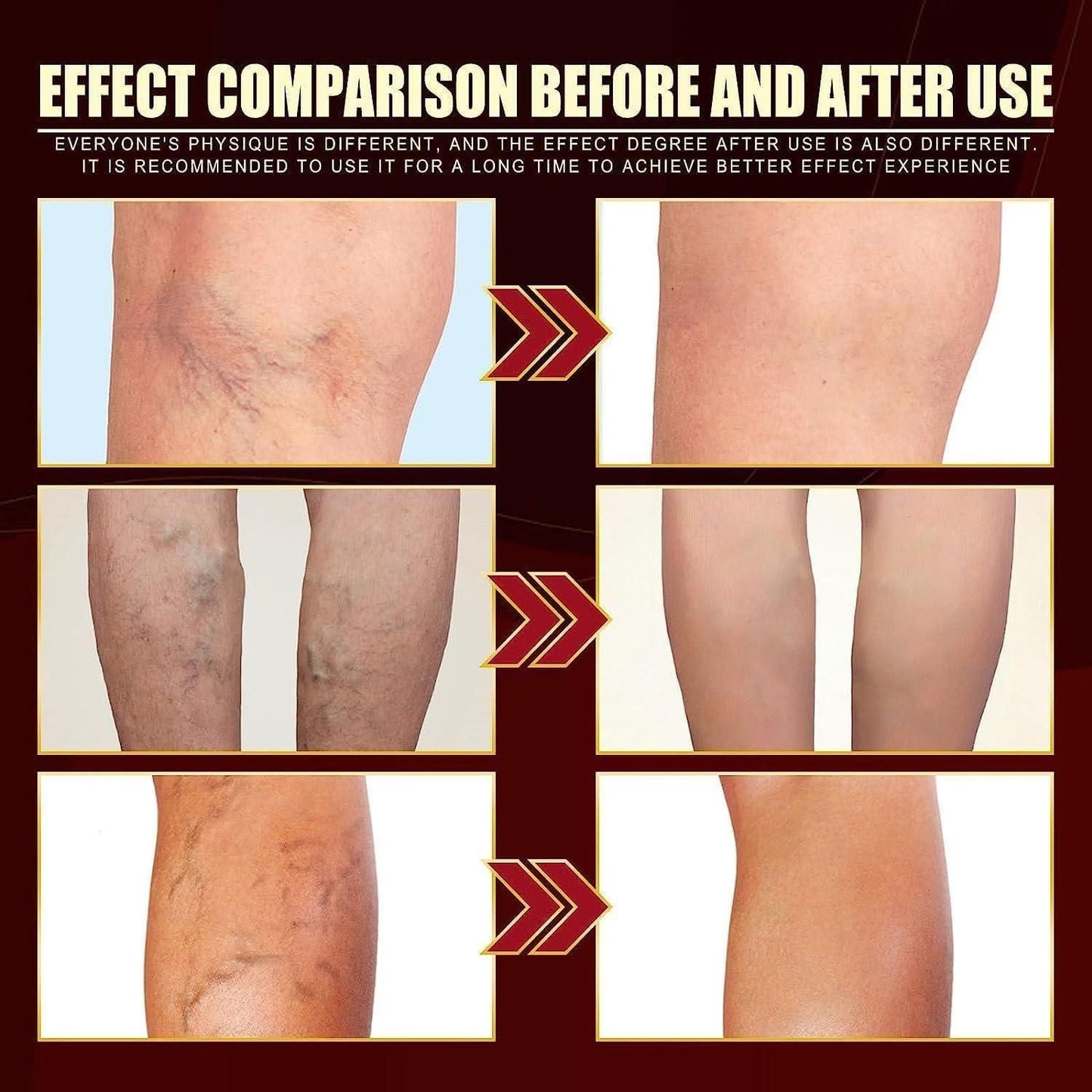 Vein Healing Varicose Veins Treatment Spray – Pack of 2  Description: