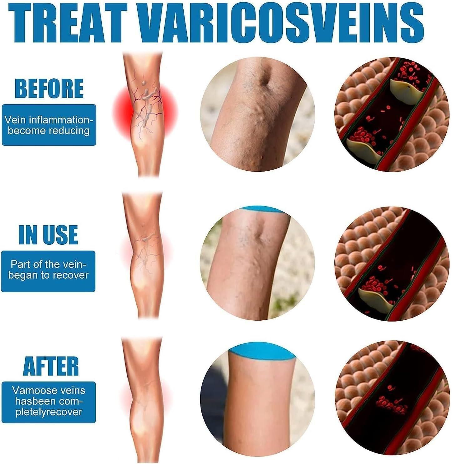 Vein Healing Varicose Veins Treatment Spray – Pack of 2  Description: