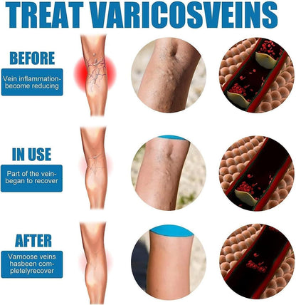 Vein Healing Varicose Veins Treatment Spray – Pack of 2  Description: